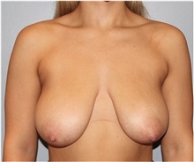 Breast Lift Before Photo by Keyian Paydar, MD, FACS; Newport Beach, CA - Case 46832
