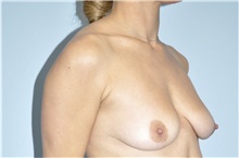 Breast Lift Before Photo by Keyian Paydar, MD, FACS; Newport Beach, CA - Case 46833