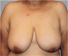 Breast Reduction Before Photo by Keyian Paydar, MD, FACS; Newport Beach, CA - Case 46862