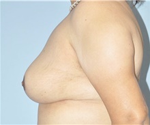 Breast Reduction After Photo by Keyian Paydar, MD, FACS; Newport Beach, CA - Case 46862