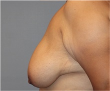 Breast Reduction Before Photo by Keyian Paydar, MD, FACS; Newport Beach, CA - Case 46862