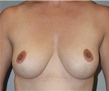Breast Reduction After Photo by Keyian Paydar, MD, FACS; Newport Beach, CA - Case 46863