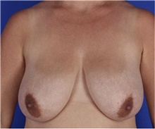 Breast Reduction Before Photo by Keyian Paydar, MD, FACS; Newport Beach, CA - Case 46863