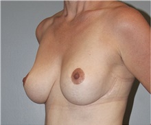 Breast Reduction After Photo by Keyian Paydar, MD, FACS; Newport Beach, CA - Case 46863