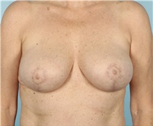 Breast Reduction After Photo by Keyian Paydar, MD, FACS; Newport Beach, CA - Case 46865