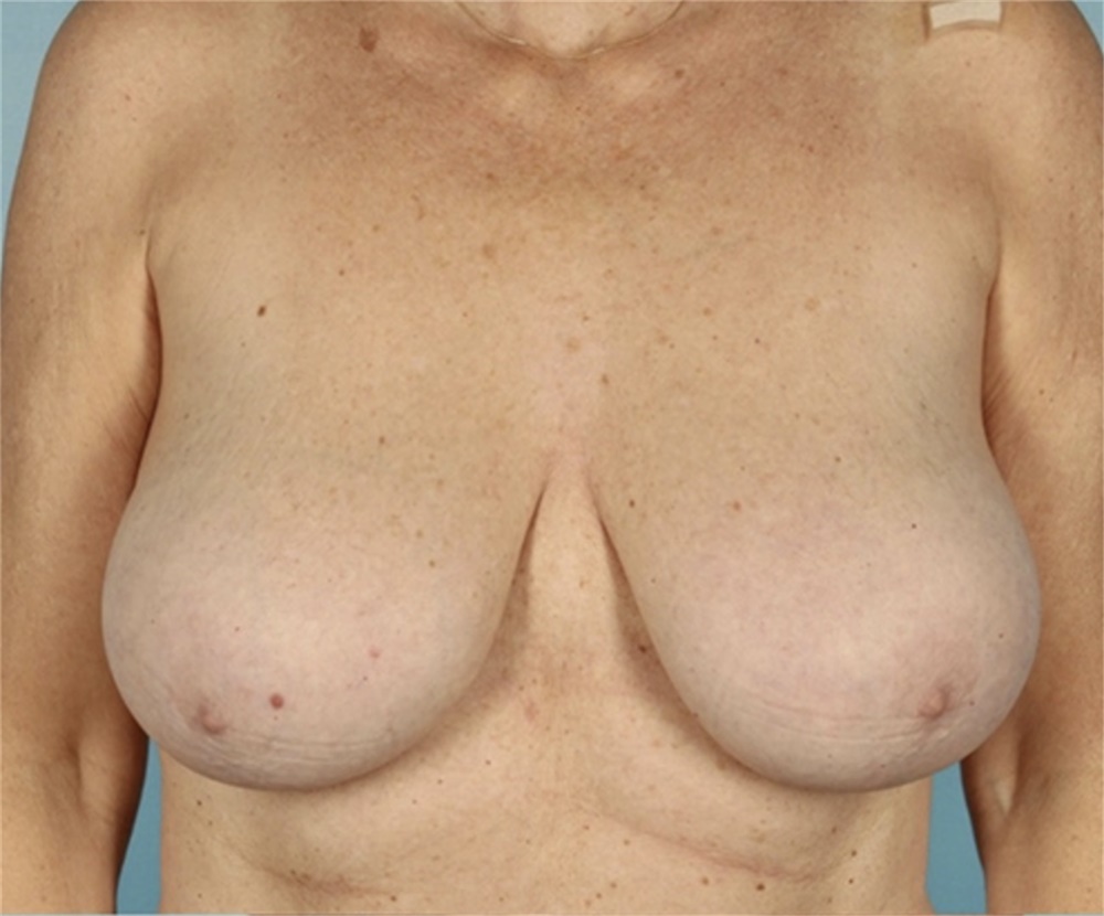 Breast Reduction DD to C Cup Before & After Photos, Newport Beach