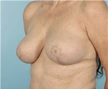 Breast Reduction After Photo by Keyian Paydar, MD, FACS; Newport Beach, CA - Case 46865