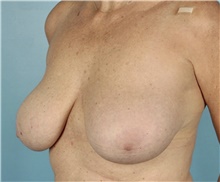 Breast Reduction Before Photo by Keyian Paydar, MD, FACS; Newport Beach, CA - Case 46865