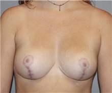 Breast Reduction After Photo by Keyian Paydar, MD, FACS; Newport Beach, CA - Case 46866