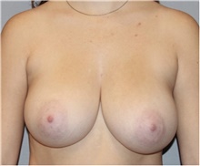 Breast Reduction Before Photo by Keyian Paydar, MD, FACS; Newport Beach, CA - Case 46866