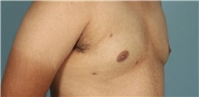 Male Breast Reduction After Photo by Keyian Paydar, MD, FACS; Newport Beach, CA - Case 46868