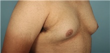 Male Breast Reduction Before Photo by Keyian Paydar, MD, FACS; Newport Beach, CA - Case 46868