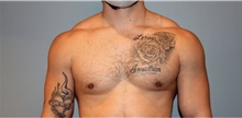 Male Breast Reduction After Photo by Keyian Paydar, MD, FACS; Newport Beach, CA - Case 46871