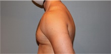 Male Breast Reduction After Photo by Keyian Paydar, MD, FACS; Newport Beach, CA - Case 46871