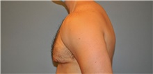 Male Breast Reduction Before Photo by Keyian Paydar, MD, FACS; Newport Beach, CA - Case 46871
