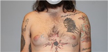 Male Breast Reduction Before Photo by Keyian Paydar, MD, FACS; Newport Beach, CA - Case 46875