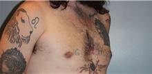 Male Breast Reduction After Photo by Keyian Paydar, MD, FACS; Newport Beach, CA - Case 46875