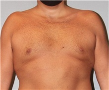 Male Breast Reduction Before Photo by Keyian Paydar, MD, FACS; Newport Beach, CA - Case 46876