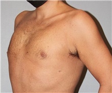 Male Breast Reduction After Photo by Keyian Paydar, MD, FACS; Newport Beach, CA - Case 46876