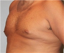 Male Breast Reduction Before Photo by Keyian Paydar, MD, FACS; Newport Beach, CA - Case 46876
