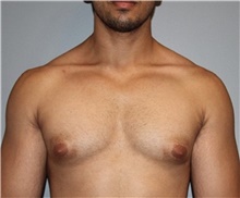 Male Breast Reduction Before Photo by Keyian Paydar, MD, FACS; Newport Beach, CA - Case 46877