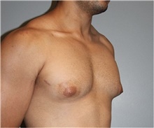 Male Breast Reduction Before Photo by Keyian Paydar, MD, FACS; Newport Beach, CA - Case 46877