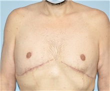 Male Breast Reduction After Photo by Keyian Paydar, MD, FACS; Newport Beach, CA - Case 46878