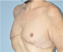 Male Breast Reduction After Photo by Keyian Paydar, MD, FACS; Newport Beach, CA - Case 46878