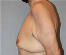 Male Breast Reduction Before Photo by Keyian Paydar, MD, FACS; Newport Beach, CA - Case 46878