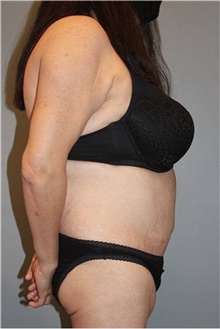 Tummy Tuck After Photo by Keyian Paydar, MD, FACS; Newport Beach, CA - Case 46879
