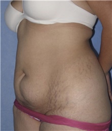 Tummy Tuck Before Photo by Keyian Paydar, MD, FACS; Newport Beach, CA - Case 46881