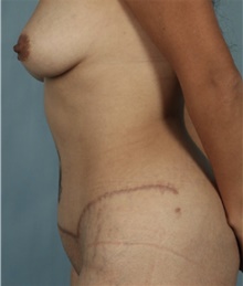 Tummy Tuck After Photo by Keyian Paydar, MD, FACS; Newport Beach, CA - Case 46881