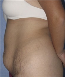 Tummy Tuck Before Photo by Keyian Paydar, MD, FACS; Newport Beach, CA - Case 46881