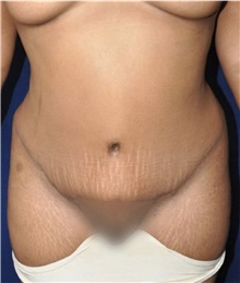 Tummy Tuck After Photo by Keyian Paydar, MD, FACS; Newport Beach, CA - Case 46884