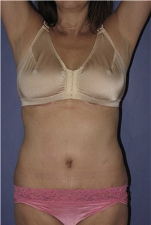 Tummy Tuck After Photo by Keyian Paydar, MD, FACS; Newport Beach, CA - Case 46885
