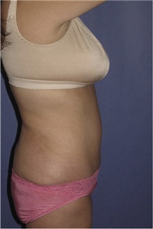 Tummy Tuck After Photo by Keyian Paydar, MD, FACS; Newport Beach, CA - Case 46885