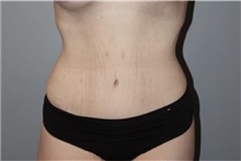Tummy Tuck After Photo by Keyian Paydar, MD, FACS; Newport Beach, CA - Case 46886