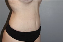Tummy Tuck After Photo by Keyian Paydar, MD, FACS; Newport Beach, CA - Case 46886