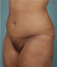 Tummy Tuck After Photo by Keyian Paydar, MD, FACS; Newport Beach, CA - Case 46888