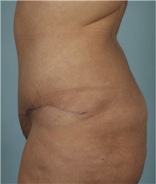 Tummy Tuck After Photo by Keyian Paydar, MD, FACS; Newport Beach, CA - Case 46888