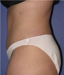 Tummy Tuck After Photo by Keyian Paydar, MD, FACS; Newport Beach, CA - Case 46889