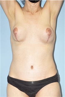Tummy Tuck After Photo by Keyian Paydar, MD, FACS; Newport Beach, CA - Case 46891