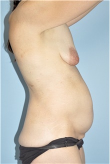Tummy Tuck Before Photo by Keyian Paydar, MD, FACS; Newport Beach, CA - Case 46891