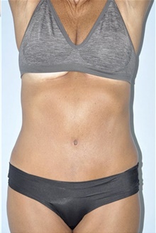 Tummy Tuck After Photo by Keyian Paydar, MD, FACS; Newport Beach, CA - Case 46892