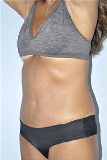Tummy Tuck After Photo by Keyian Paydar, MD, FACS; Newport Beach, CA - Case 46892