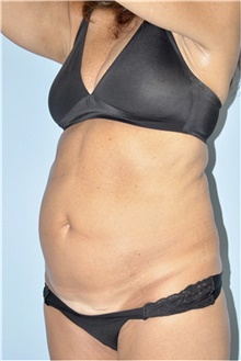 Tummy Tuck Before Photo by Keyian Paydar, MD, FACS; Newport Beach, CA - Case 46892