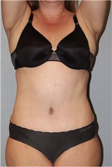 Tummy Tuck After Photo by Keyian Paydar, MD, FACS; Newport Beach, CA - Case 46894
