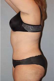 Tummy Tuck After Photo by Keyian Paydar, MD, FACS; Newport Beach, CA - Case 46894