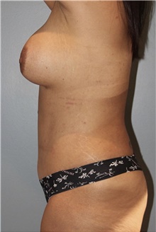 Tummy Tuck After Photo by Keyian Paydar, MD, FACS; Newport Beach, CA - Case 46895