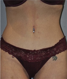Tummy Tuck After Photo by Keyian Paydar, MD, FACS; Newport Beach, CA - Case 46896